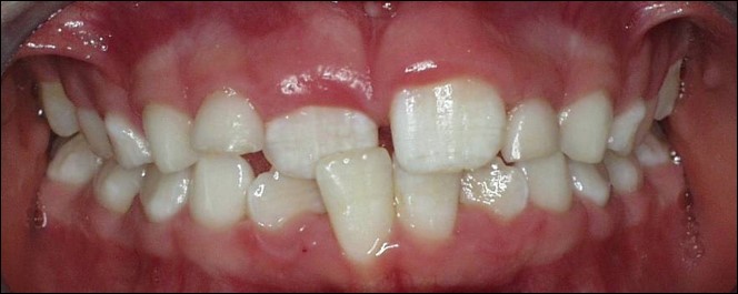 common bite problems: anterior crossbite