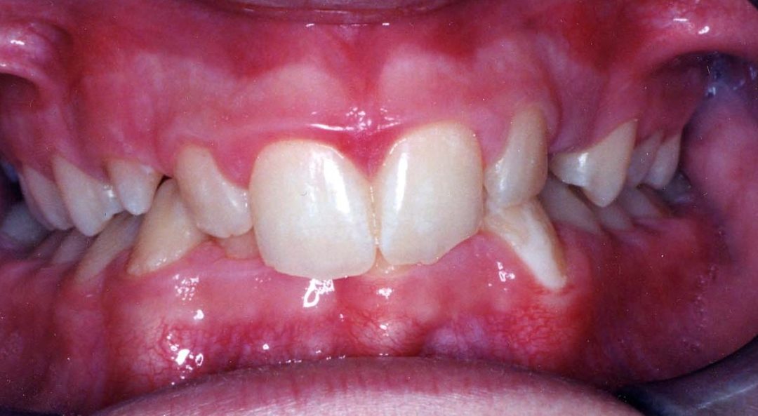 7 Common Bite Problems American Association of Orthodontists