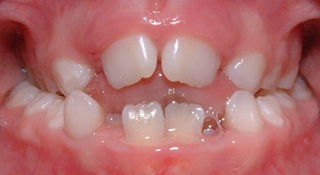 7 Types Of Bite Problems and Their Orthodontic Solutions American