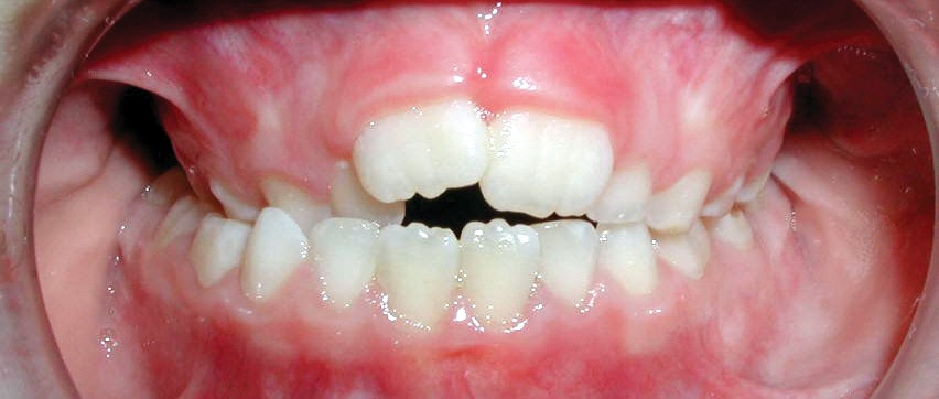 common bite problems: posterior crossbite