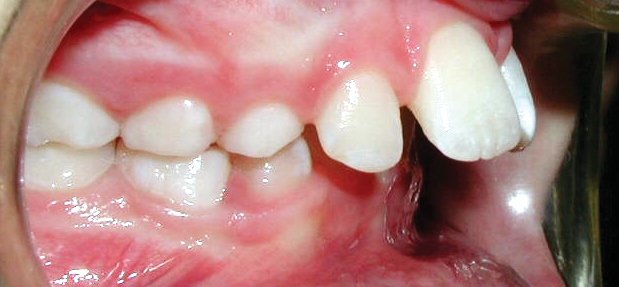 common bite problems: protrusion