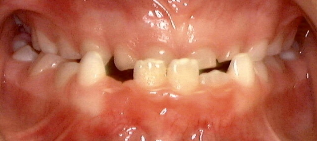 common bite problems: underbite