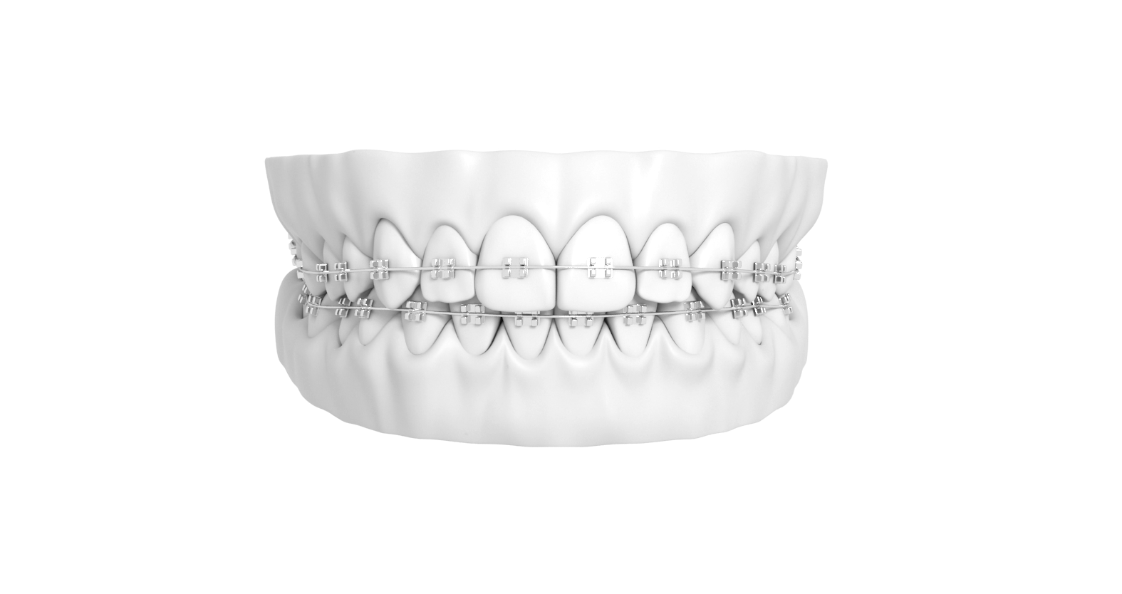 How Braces Work A Comprehensive Guide American Association of